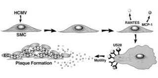 Atherosclerotic plaque formation Atherosclerotic plaque formation