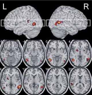fMRI image showing right and left side brain activations. fMRI image showing right and left side brain activations.