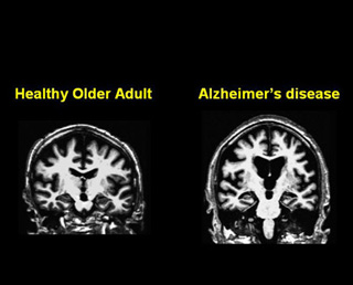 Two MRI images side by side. One shows the brain of a healthy older adult, the other shows a brain of an adult with Alzheimer's disease. Two MRI images side by side. One shows the brain of a healthy older adult, the other shows a brain of an adult with Alzheimer's disease.