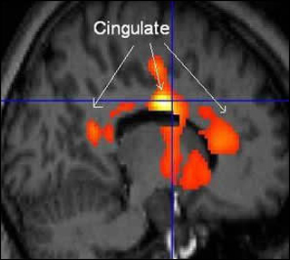 Statistically-analyzed PET scan data superimposed on structural MRI scan. Statistically-analyzed PET scan data superimposed on structural MRI scan.