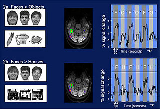 Comparison of sample fMRI scans of the brains of subjects. Comparison of sample fMRI scans of the brains of subjects.