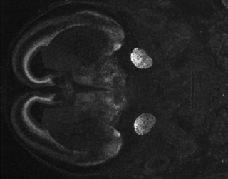 Visualization of the visual cortex in a developing brain. Visualization of the visual cortex in a developing brain.