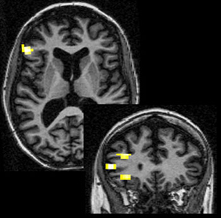 Image showing activation in the frontal cortex of a patient with global amnesia. Image showing activation in the frontal cortex of a patient with global amnesia.