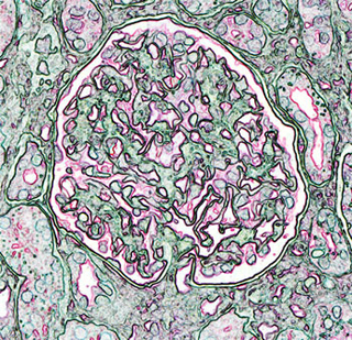 Artistic rendition of a kidney glomerulus. Artistic rendition of a kidney glomerulus.