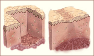 Two cross-section diagrams of skin, showing injury and scarred healing. Two cross-section diagrams of skin, showing injury and scarred healing.