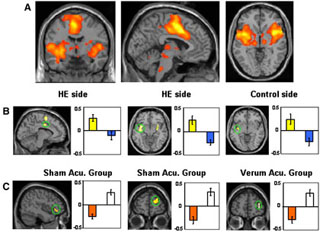 fMRI images and bar charts comparing responses to verum and sham acupuncture treatments. fMRI images and bar charts comparing responses to verum and sham acupuncture treatments.