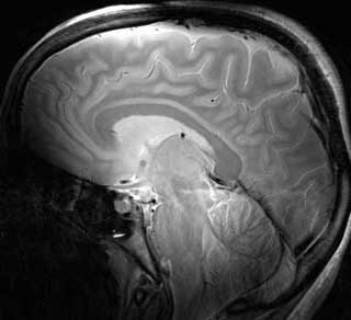 An MRI image of a human brain. An MRI image of a human brain.