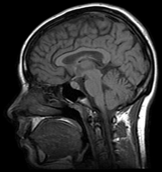 MRI image of a human head MRI image of a human head