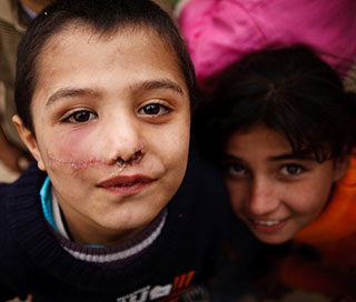 A photograph of two children in Gaza City – one child has visible stitches under his nose and across his cheek. A photograph of two children in Gaza City – one child has visible stitches under his nose and across his cheek.